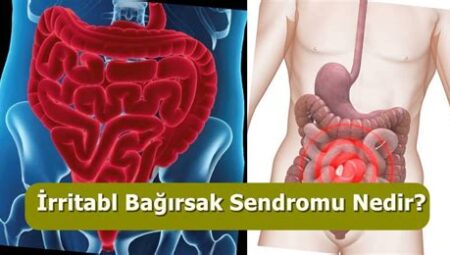 İrritabl Bağırsak Sendromu (IBS) Nedir?