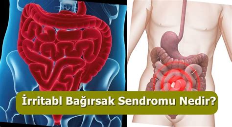 İrritabl Bağırsak Sendromu (IBS) Nedir?